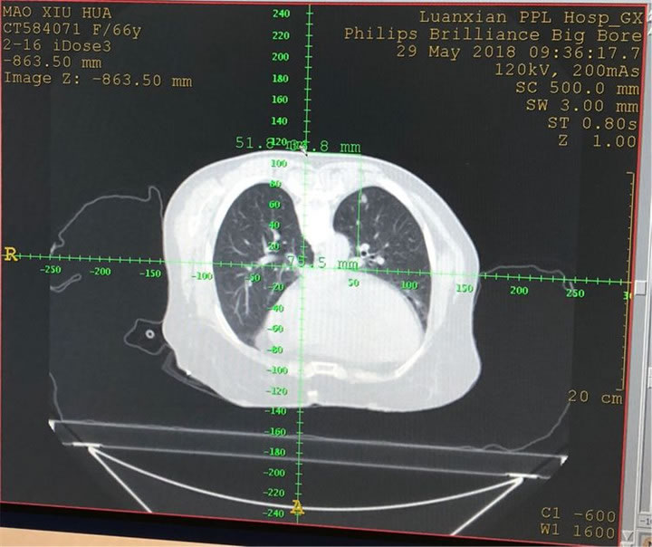 經(jīng)典病例之穿刺模板引導(dǎo)肺小結(jié)節(jié)同針道活檢消融1 經(jīng)典病例之穿刺模板引導(dǎo)肺小結(jié)節(jié)同針道活檢消融1
