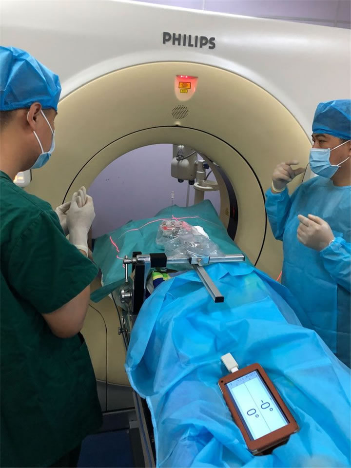 經(jīng)典病例之穿刺模板引導(dǎo)肺小結(jié)節(jié)同針道活檢消融3 經(jīng)典病例之穿刺模板引導(dǎo)肺小結(jié)節(jié)同針道活檢消融3