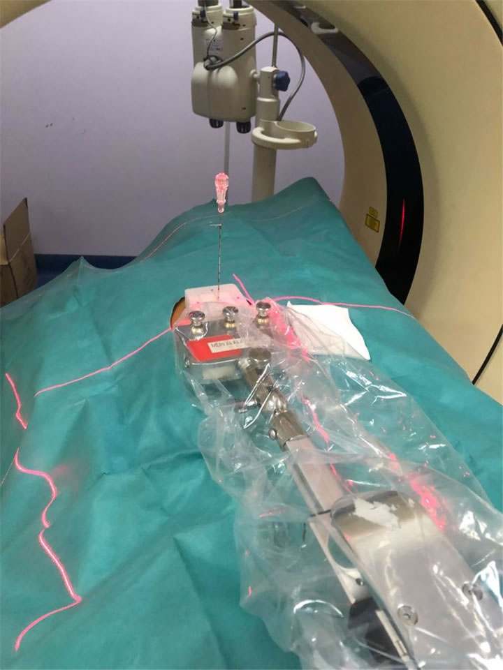 經(jīng)典病例之穿刺模板引導(dǎo)肺小結(jié)節(jié)同針道活檢消融4 經(jīng)典病例之穿刺模板引導(dǎo)肺小結(jié)節(jié)同針道活檢消融4