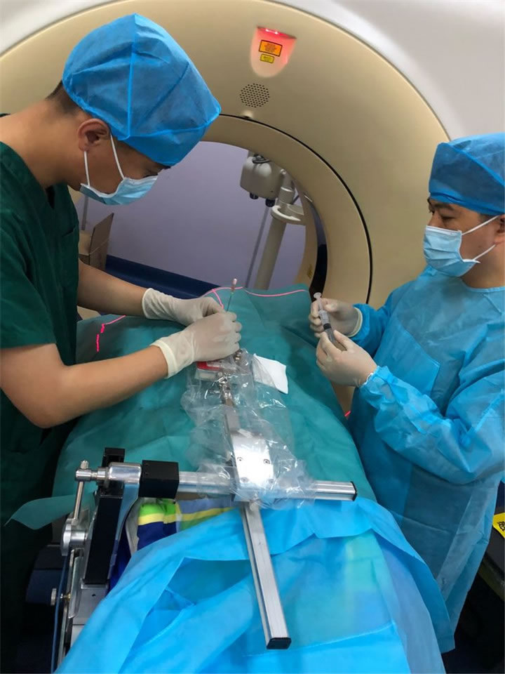 經(jīng)典病例之穿刺模板引導(dǎo)肺小結(jié)節(jié)同針道活檢消融5