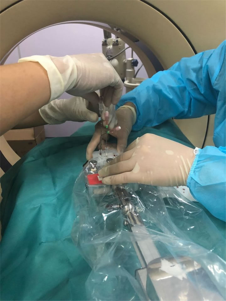 經(jīng)典病例之穿刺模板引導(dǎo)肺小結(jié)節(jié)同針道活檢消融7 經(jīng)典病例之穿刺模板引導(dǎo)肺小結(jié)節(jié)同針道活檢消融7