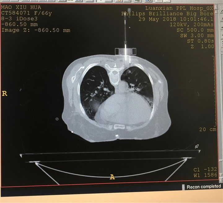 經(jīng)典病例之穿刺模板引導(dǎo)肺小結(jié)節(jié)同針道活檢消融8 經(jīng)典病例之穿刺模板引導(dǎo)肺小結(jié)節(jié)同針道活檢消融8