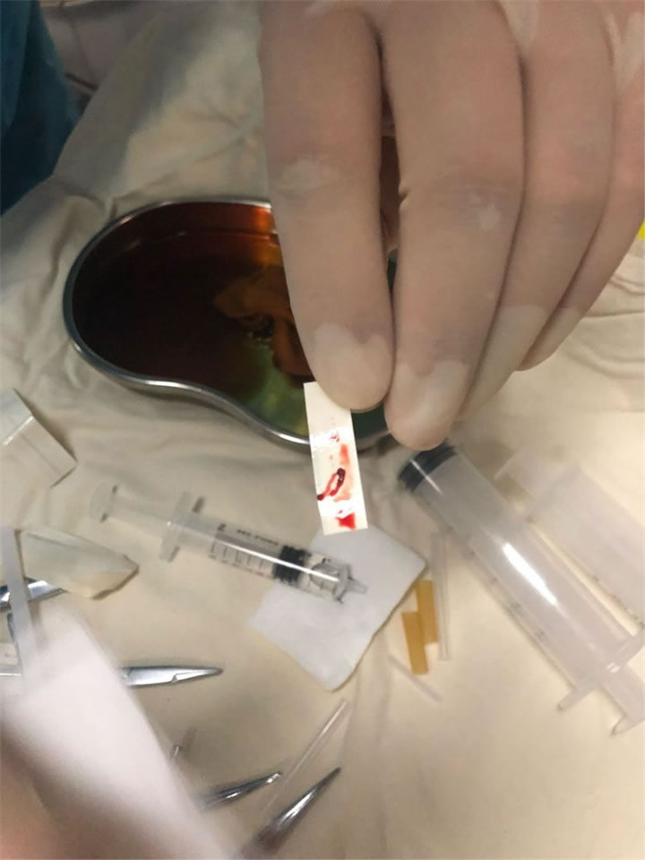 經(jīng)典病例之穿刺模板引導(dǎo)肺小結(jié)節(jié)同針道活檢消融10