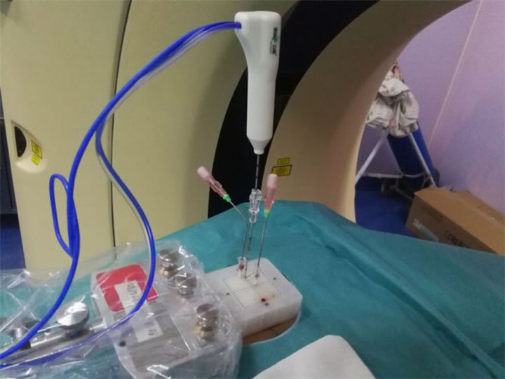 經(jīng)典病例之穿刺模板引導(dǎo)肺小結(jié)節(jié)同針道活檢消融11