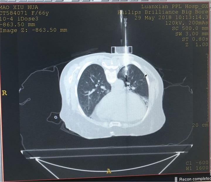 經(jīng)典病例之穿刺模板引導(dǎo)肺小結(jié)節(jié)同針道活檢消融 經(jīng)典病例之穿刺模板引導(dǎo)肺小結(jié)節(jié)同針道活檢消融13