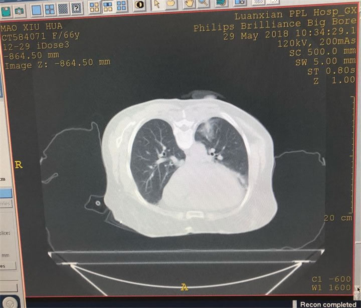 經(jīng)典病例之穿刺模板引導(dǎo)肺小結(jié)節(jié)同針道活檢消融14 經(jīng)典病例之穿刺模板引導(dǎo)肺小結(jié)節(jié)同針道活檢消融14