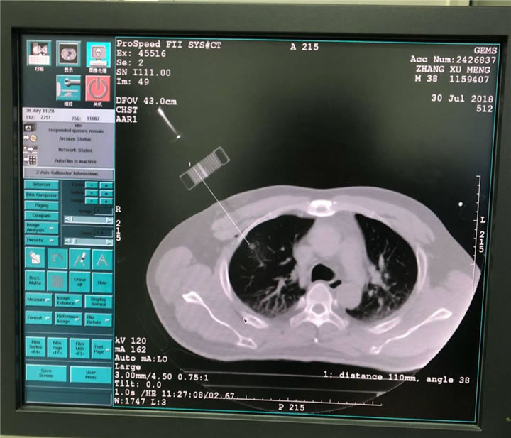 唐山市人民醫(yī)院陳寶明教授團(tuán)隊采用共面模板穿刺技術(shù)行肺小結(jié)節(jié)射頻消融一例分享4