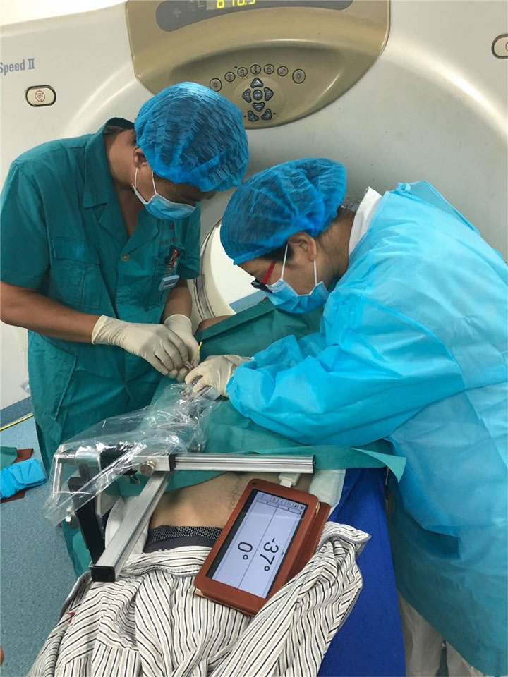 唐山市人民醫(yī)院陳寶明教授團(tuán)隊采用共面模板穿刺技術(shù)行肺小結(jié)節(jié)射頻消融一例分享5