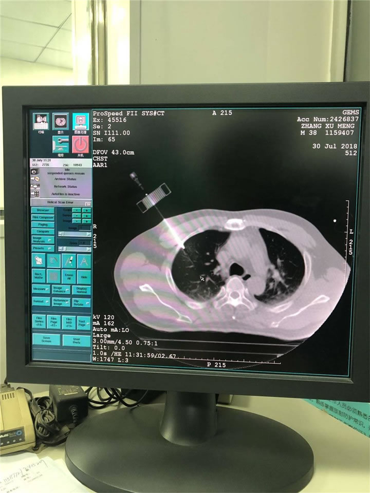 唐山市人民醫(yī)院陳寶明教授團(tuán)隊采用共面模板穿刺技術(shù)行肺小結(jié)節(jié)射頻消融一例分享6