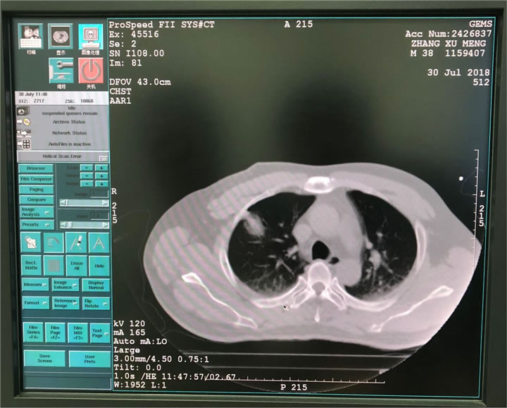 唐山市人民醫(yī)院陳寶明教授團(tuán)隊采用共面模板穿刺技術(shù)行肺小結(jié)節(jié)射頻消融一例分享10